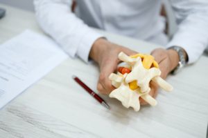 Close up view of doctor holds in his hands a model of the lumbar disc of the spine with a hernia