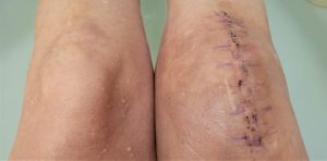 Comparing Knees Post Op Full Knee Joint Replacement Surgery! Wound Healing Nice & Little Scarring!