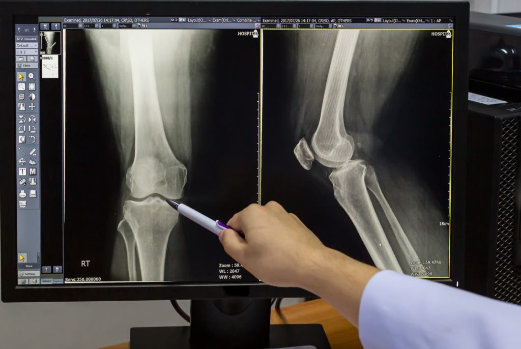 Doctor pointing on the knee problem point on x-ray film.