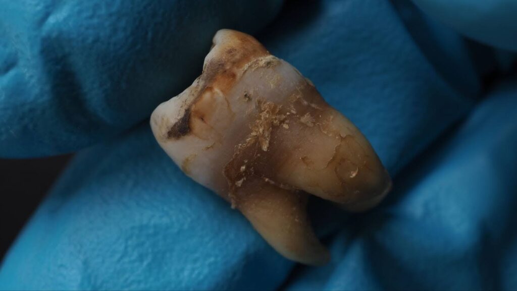 Tooth rotting held in hand wearing a blue latex glove. 